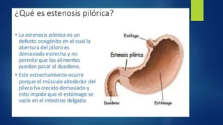 EXPO ANESTESIA EN IHPS ESTENOSIS PILORICA.pptx