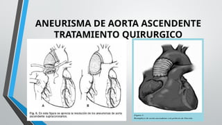 EXPOSICION ANEURISMA DE AORTA TORÁCICA.pptx