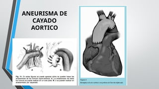 EXPOSICION ANEURISMA DE AORTA TORÁCICA.pptx