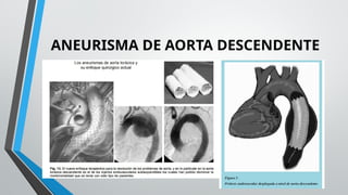 EXPOSICION ANEURISMA DE AORTA TORÁCICA.pptx