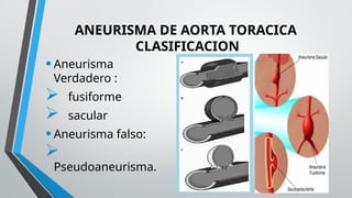 EXPOSICION ANEURISMA DE AORTA TORÁCICA.pptx