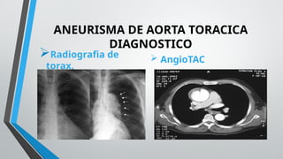 EXPOSICION ANEURISMA DE AORTA TORÁCICA.pptx