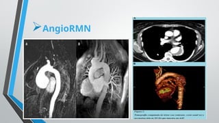 EXPOSICION ANEURISMA DE AORTA TORÁCICA.pptx