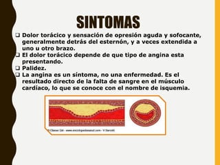 SINTOMAS
 Dolor torácico y sensación de opresión aguda y sofocante,
generalmente detrás del esternón, y a veces extendida a
uno u otro brazo.
 El dolor torácico depende de que tipo de angina esta
presentando.
 Palidez.
 La angina es un síntoma, no una enfermedad. Es el
resultado directo de la falta de sangre en el músculo
cardíaco, lo que se conoce con el nombre de isquemia.
 