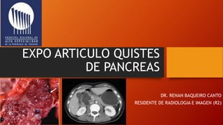 EXPO ARTICULO QUISTES
DE PANCREAS
DR. RENAN BAQUEIRO CANTO
RESIDENTE DE RADIOLOGIA E IMAGEN (R2)
 