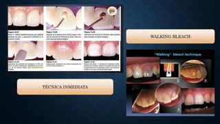 TÉCNICA INMEDIATA
WALKING BLEACH
 