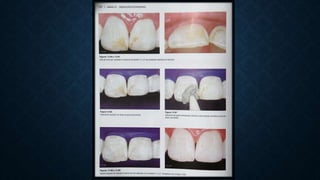 Blanqueamiento dental