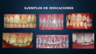 EJEMPLOS DE INDICACIONES
 