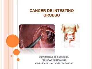 CANCER DE INTESTINO 
GRUESO 
UNIVERSIDAD DE GUAYAQUIL 
FACULTAD DE MEDICINA 
CATEDRA DE GASTROENTEROLOGIA 
 