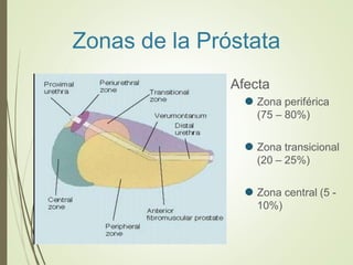 Zonas de la Próstata
Afecta
⚫ Zona periférica
(75 – 80%)
⚫ Zona transicional
(20 – 25%)
⚫ Zona central (5 -
10%)
 