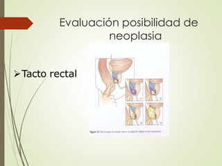 Evaluación posibilidad de
neoplasia
Tacto rectal
 