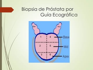 Biopsia de Próstata por
Guía Ecográfica
1
2
3
4
5
6
Der Izq
 