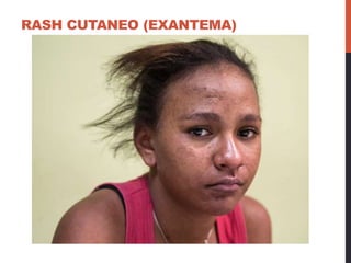 RASH CUTANEO (EXANTEMA)
 