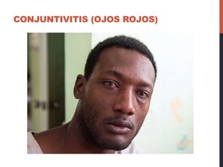 CONJUNTIVITIS (OJOS ROJOS)
 