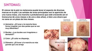 SINTOMAS:
El cáncer de la piel no melanoma puede tener el aspecto de diversas
marcas en la piel. Las señales de aviso principales son la aparición de
una nueva masa, una mancha o protuberancia que esté creciendo (en el
transcurso de unos meses o de uno a dos años), o bien una úlcera que
no sane en un plazo de tres meses.
 Asimetría: ¿El lunar o la mancha tiene
forma irregular con dos partes que se ven
muy diferentes?
 Bordes: ¿Los bordes son irregulares o
dentados?
 Color: ¿El color es disparejo.
 Diámetro: ¿El lunar o la mancha es más
grande que una arveja
Micosis Fungoide
 