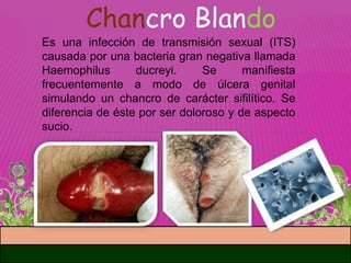 enfermedades de transmicion sexual | PPTX