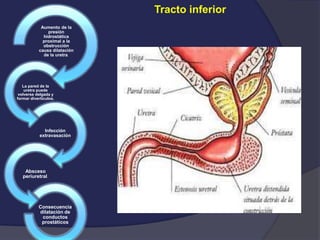 Tracto inferior
Aumento de la
presión
hidrostática
proximal a la
obstrucción
causa dilatación
de la uretra.
La pared de la
uretra puede
volverse delgada y
formar divertículos.
Infección
extravasación
Absceso
periuretral.
Consecuencia
dilatación de
conductos
prostáticos
 
