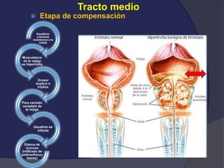 Tracto medio
 Etapa de compensación
Equilibrio
creciente
resistencia a la
salida
Musculatura
de la vejiga
se hipertrofia
Grosor
duplica o
triplica
Para vaciado
completo de
la vejiga
Usualme se
infecta
Edema de
mucosa
(infiltrado de
polimorfonuc
leares)
 