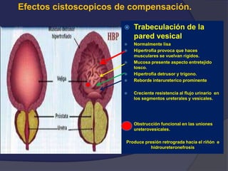 Efectos cistoscopicos de compensación.
 Trabeculación de la
pared vesical
 Normalmente lisa
 Hipertrofia provoca que haces
musculares se vuelvan rígidos.
 Mucosa presente aspecto entretejido
tosco.
 Hipertrofia detrusor y trígono.
 Reborde interureterico prominente
 Creciente resistencia al flujo urinario en
los segmentos ureterales y vesicales.
 Obstrucción funcional en las uniones
ureterovesicales.
Produce presión retrograda hacia el riñón e
hidroureteronefrosis
 