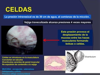 CELDAS
La presión intravesical es de 30 cm de agua, al comienzo de la micción.
Vejiga traveculizada alcanza presiones 4 veces mayores
Esta presión provoca el
desplazamiento de la
mucosa entre los haces
musculares formando
bolsas o celdas.
Celdas se introducen en la musculatura
Convierten en sáculos
Divertículos carentes de pared muscular
No expulsión de contenido a la vejiga
MUCOSA: enrojecida , edematosa
Adelgazada y pálida.
Provoca reflujo vesicoureteral
 