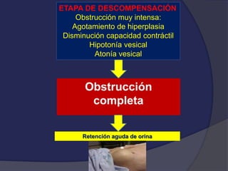 ETAPA DE DESCOMPENSACIÓN
Obstrucción muy intensa:
Agotamiento de hiperplasia
Disminución capacidad contráctil
Hipotonía vesical
Atonía vesical
Obstrucción
completa
Retención aguda de orina
 