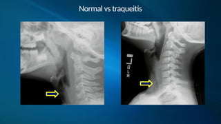 Traqueitis Rx EXPO CMP DIPLOMADO PEDIATRIA - 2 TORAX 2.pptx