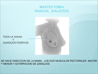 SE HACE DISECCION DE LA MAMA,  LOS DOS MUSCULOS PECTORALES  MAYOR Y MENOR Y EXTIRPACION DE GANGLIOS  TODA LA MAMA  Y  GANGLIOS POSITIVOS  MASTECTOMIA RADICAL  (HALSTED) 