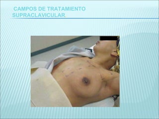 CAMPOS DE TRATAMIENTO SUPRACLAVICULAR . 