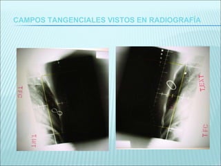 CAMPOS TANGENCIALES VISTOS EN RADIOGRAFÍA 