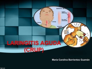 LARINGITIS AGUDA
(CRUP)
María Carolina Barrientos Guzmán
 