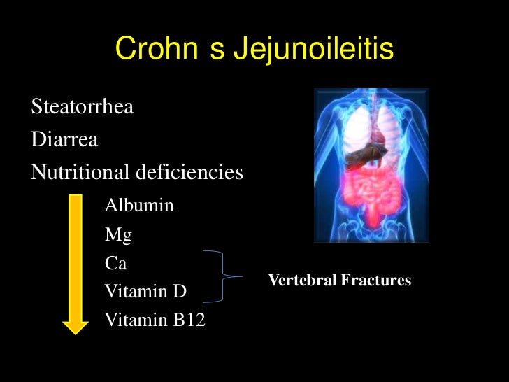 Ulcerative Colitis Crohn's Disease