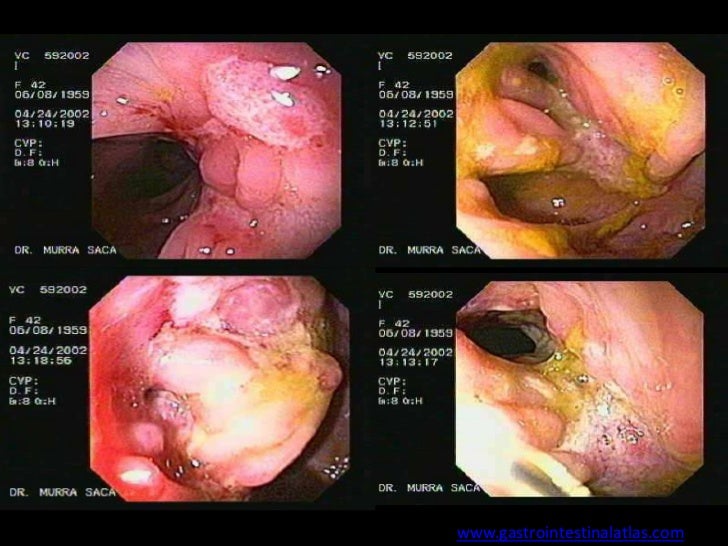Purinethol Ulcerative Colitis