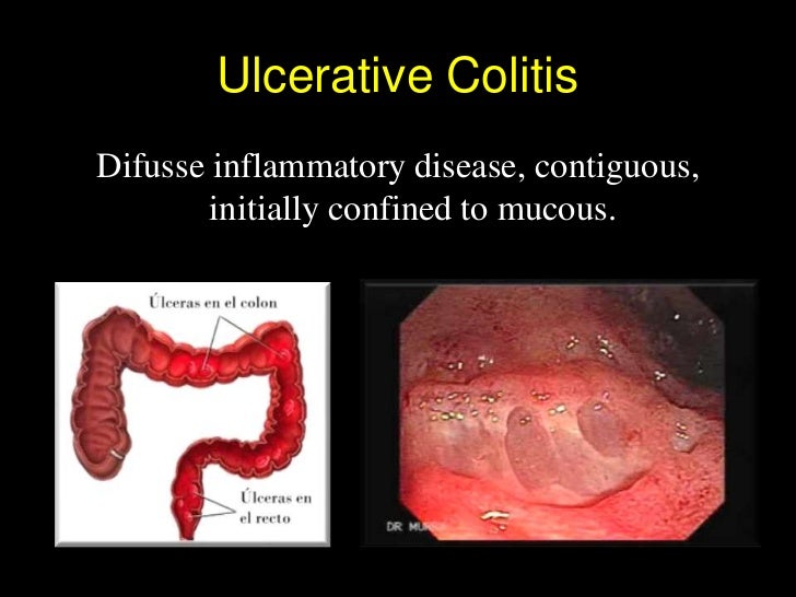 Ulcerative Colitis Crohn's Disease