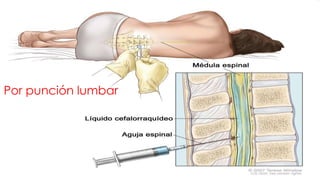Por punción lumbar

 