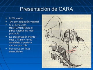 Presentación de CARAPresentación de CARA
 0.2% casos0.2% casos
 Dx por palpación vaginalDx por palpación vaginal
 Si el bebé estáSi el bebé está
MENTOANTERIOR elMENTOANTERIOR el
parto vaginal es masparto vaginal es mas
probableprobable
 La presentación Mento –La presentación Mento –
Post o Transv no esPost o Transv no es
candidata a parto acandidata a parto a
menos que rotemenos que rote
 frecuente en fetosfrecuente en fetos
anencéfalosanencéfalos
 