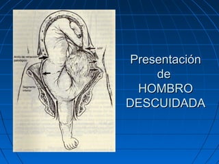 PresentaciónPresentación
dede
HOMBROHOMBRO
DESCUIDADADESCUIDADA
 