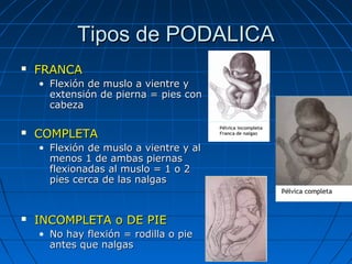 Tipos de PODALICATipos de PODALICA
 FRANCAFRANCA
• Flexión de muslo a vientre yFlexión de muslo a vientre y
extensión de pierna = pies conextensión de pierna = pies con
cabezacabeza
 COMPLETACOMPLETA
• Flexión de muslo a vientre y alFlexión de muslo a vientre y al
menos 1 de ambas piernasmenos 1 de ambas piernas
flexionadas al muslo = 1 o 2flexionadas al muslo = 1 o 2
pies cerca de las nalgaspies cerca de las nalgas
 INCOMPLETA o DE PIEINCOMPLETA o DE PIE
• No hay flexión = rodilla o pieNo hay flexión = rodilla o pie
antes que nalgasantes que nalgas
 
