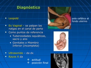 DiagnósticoDiagnóstico
 LeopoldLeopold
 Ex Vaginal –Ex Vaginal – se palpan lasse palpan las
nalgas en el canal de partonalgas en el canal de parto
 Como puntos de referenciaComo puntos de referencia
• Tuberosidades isquiáticas,Tuberosidades isquiáticas,
sacro y anosacro y ano
• Genitales o MiembroGenitales o Miembro
Inferior (incompleta)Inferior (incompleta)
 UltrasonidoUltrasonido – da dx– da dx
 Rayos XRayos X dada
 actitud
 posición final
polo cefálico al
fondo uterino
 