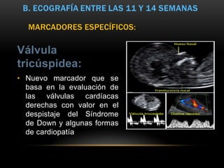 MARCADORES ESPECÍFICOS:

Válvula
tricúspidea:
• Nuevo marcador que se
  basa en la evaluación de
  las   válvulas cardíacas
  derechas con valor en el
  despistaje del Síndrome
  de Down y algunas formas
  de cardiopatía
 
