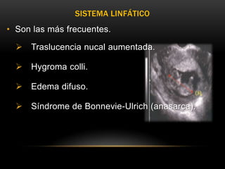 SISTEMA LINFÁTICO
• Son las más frecuentes.

   Traslucencia nucal aumentada.

   Hygroma colli.

   Edema difuso.

   Síndrome de Bonnevie-Ulrich (anasarca).
 