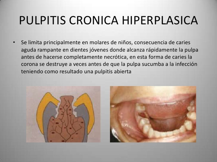 Pulpitis Skin Histologia De La Pulpitis INNOVACIONES EN ODONTOPEDIATRIA: TERAPIA
