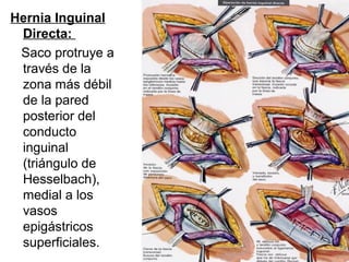 Hernia Inguinal
Directa:
Saco protruye a
través de la
zona más débil
de la pared
posterior del
conducto
inguinal
(triángulo de
Hesselbach),
medial a los
vasos
epigástricos
superficiales.
 
