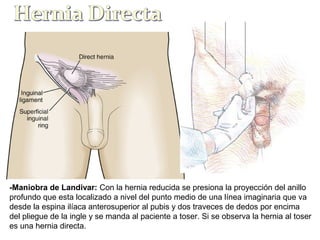 -Maniobra de Landivar: Con la hernia reducida se presiona la proyección del anillo
profundo que esta localizado a nivel del punto medio de una línea imaginaria que va
desde la espina ilíaca anterosuperior al pubis y dos traveces de dedos por encima
del pliegue de la ingle y se manda al paciente a toser. Si se observa la hernia al toser
es una hernia directa.
 