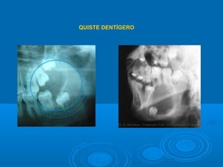 QUISTE DENTÍGERO
 