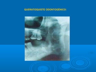 QUERATOQUISTE ODONTOGÉNICO:
 