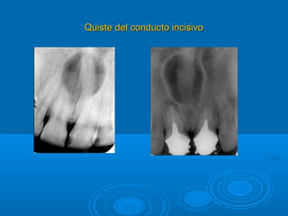 Quiste del conducto incisivoQuiste del conducto incisivo
 
