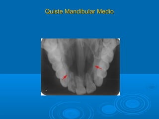 Quiste Mandibular MedioQuiste Mandibular Medio
 