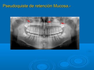 Pseudoquiste de retención Mucosa.-Pseudoquiste de retención Mucosa.-
 