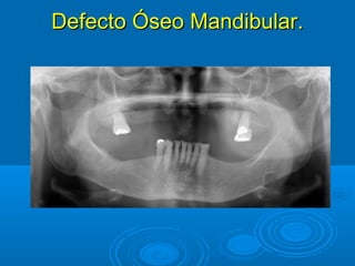 Defecto Óseo Mandibular.Defecto Óseo Mandibular.
 