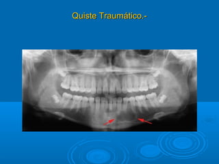 Quiste Traumático.-Quiste Traumático.-
 